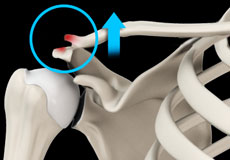 AC Joint Dislocation/Acromioclavicular Joint Dislocation