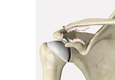 AC Joint Separation