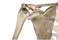 Acromioclavicular (AC) Joint Osteoarthritis