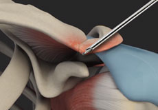 AC Joint Stabilisation