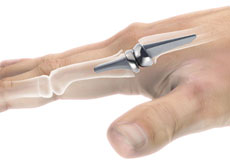 Surgery for Thumb and Digit Arthritis