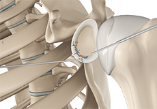 Bony Instability Reconstruction of the Shoulder