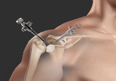 Complex Shoulder Reconstruction