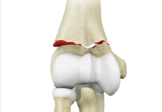 Distal Humerus Fractures of the Elbow