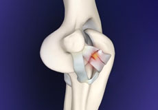 Elbow Ligament Injuries