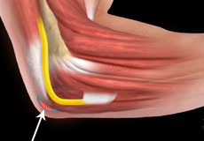 Elbow (Olecranon) Bursitis