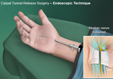 Endoscopic Carpal Tunnel Surgery