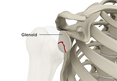 Glenoid Fractures