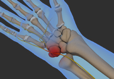 Ulnar Nerve Compression in Guyon's Canal