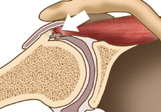 Internal Impingement of the Shoulder