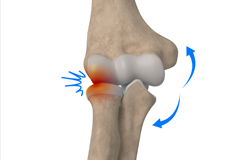 Lateral Impingement of the Elbow