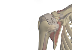 Latissimus Dorsi Tendon Transfer