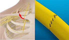 Nerve Transfers