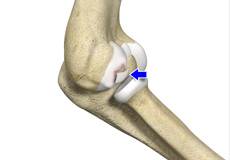 Osteochondritis Dissecans of Elbow