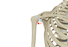 Posterior Shoulder Instability