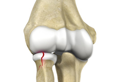 Radial Head Fractures of the Elbow