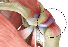 Rotator Cuff Pain