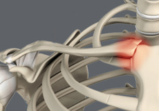 Sternoclavicular Separation