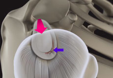 Shoulder Labral Tear with Instability