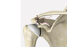 Shoulder Ligament Injuries