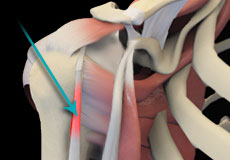 Shoulder Tendonitis