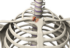 Sternoclavicular Arthritis