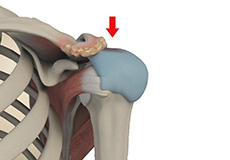 Subacromial Impingement Syndrome